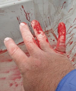 bleeding-hand